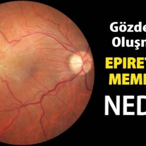 Epiretinal-membran tedavisi