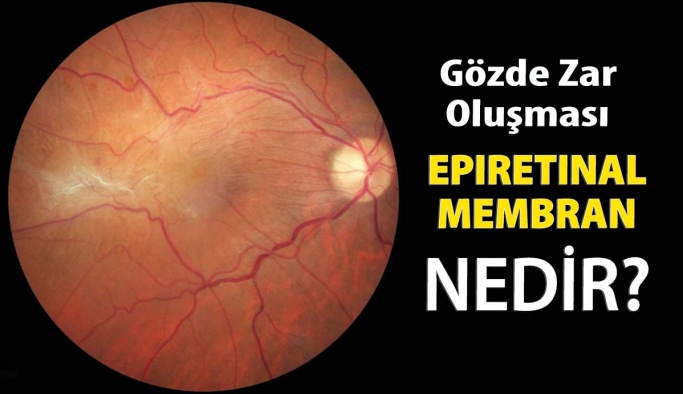 Epiretinal-membran tedavisi Epiretinal-membran tedavisi