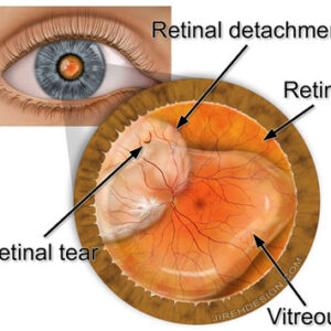 retina-dekolmani retina-dekolmani