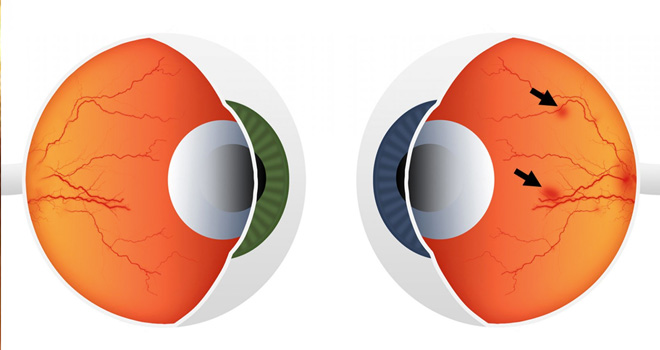 diyabetik-retinopati-2 diyabetik-retinopati-2
